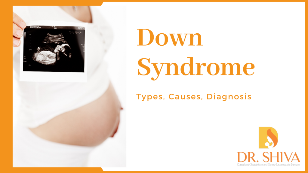 Down Syndrome Types, Causes and Treatment Dr. Shiva