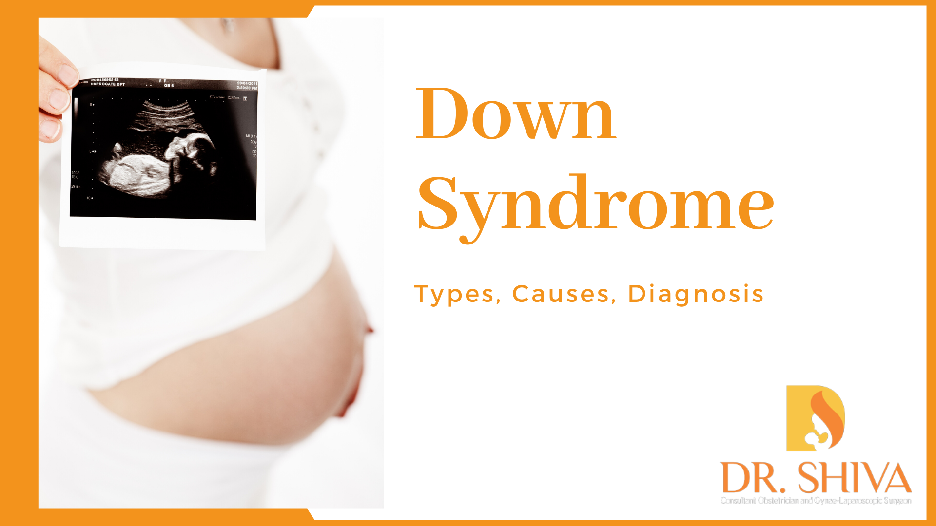 Down Syndrome - Types, Causes & Diagnosis