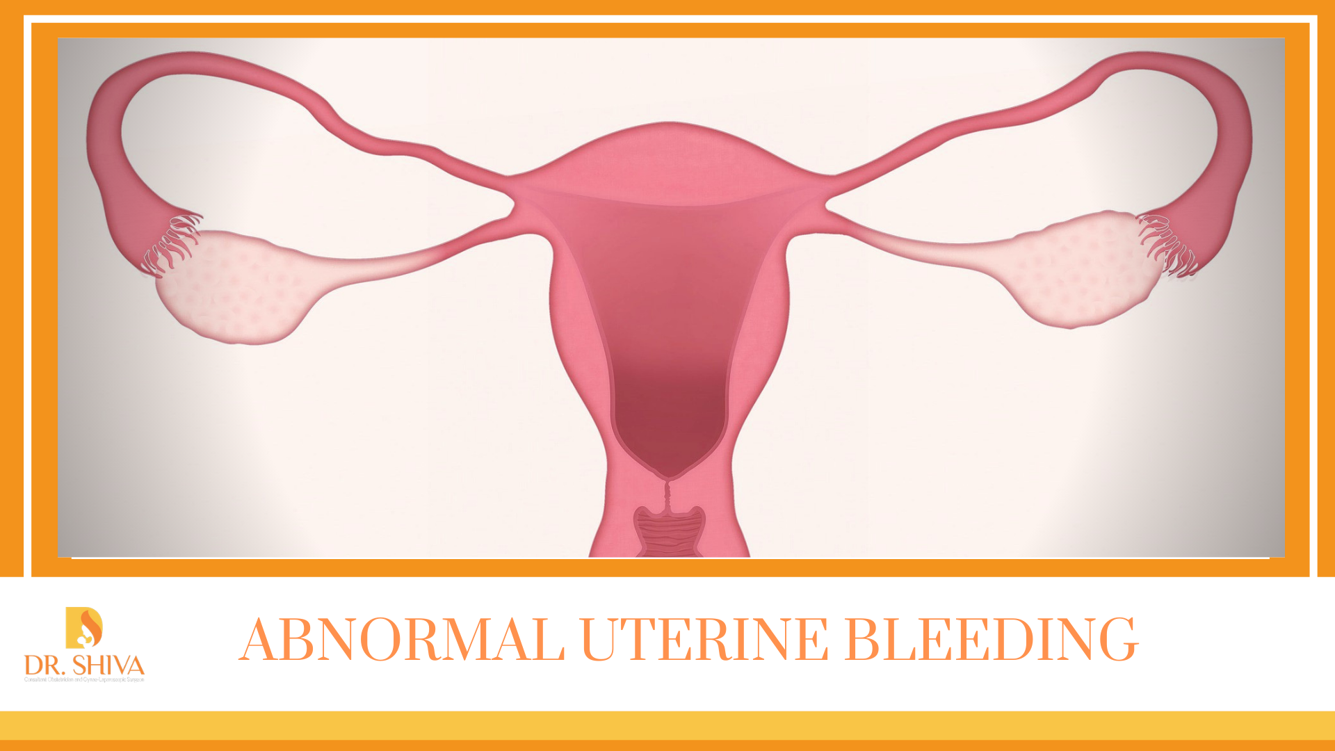 Abnormal uterine bleeding (AUB) is bleeding from the uterus that is longer  than usual or that occurs at an irregular time. Bleeding may b