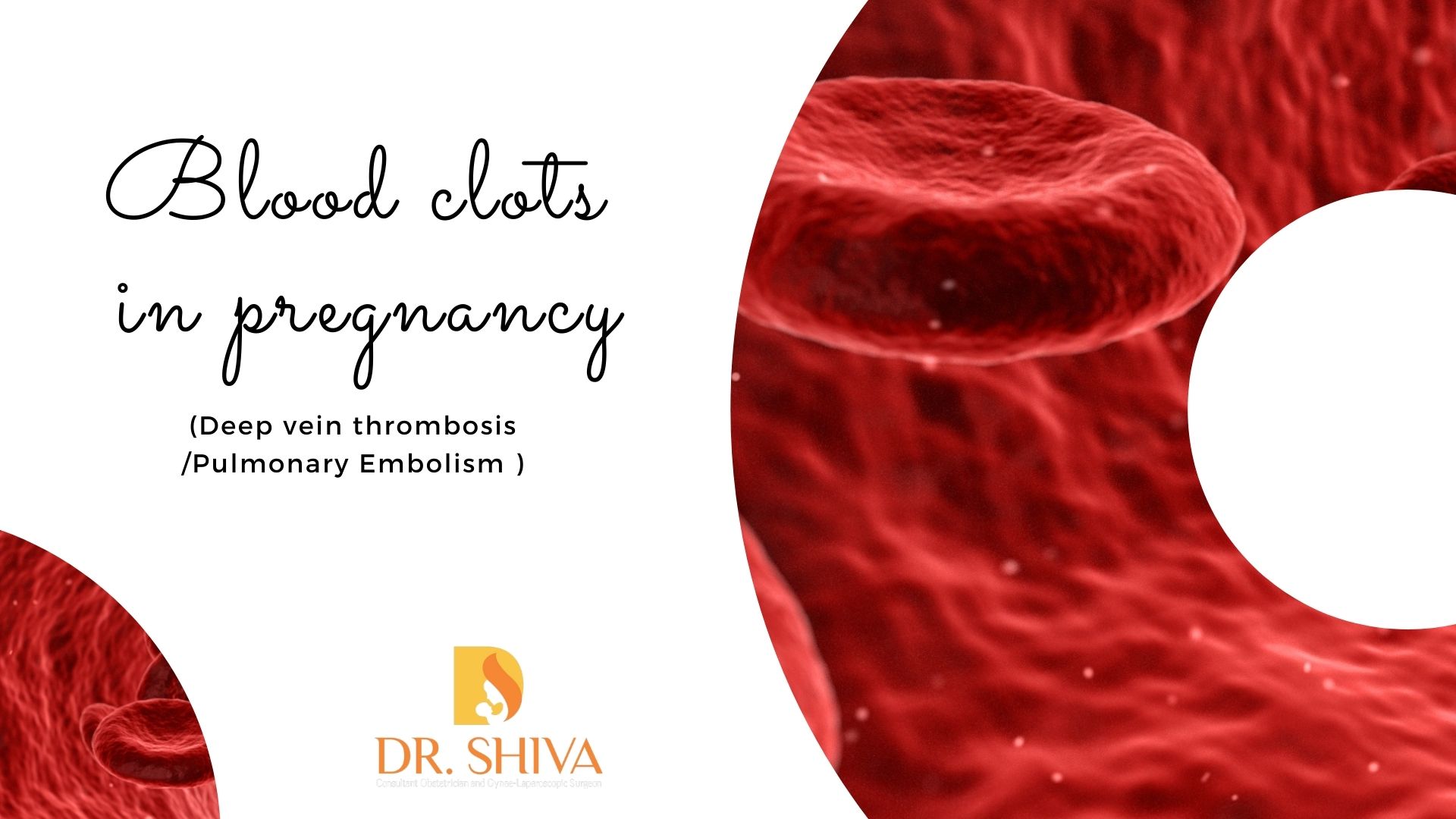 Blood clots during pregnancy (DVT/PE)