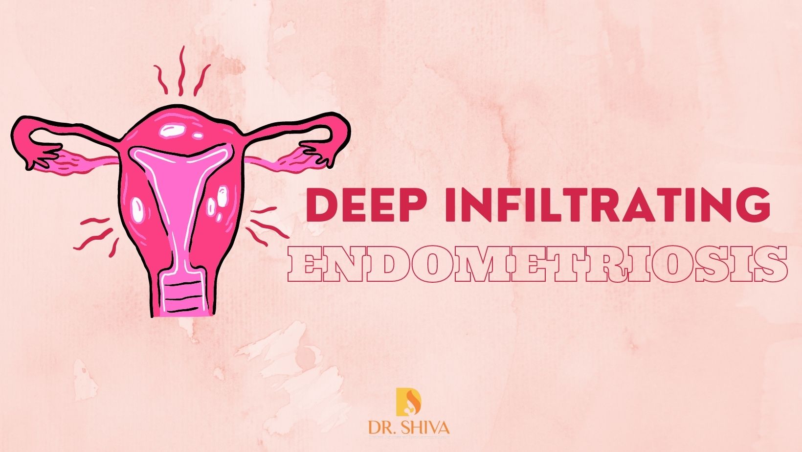 Deep infiltrating endometriosis - Dr.Shiva Harikrishnan