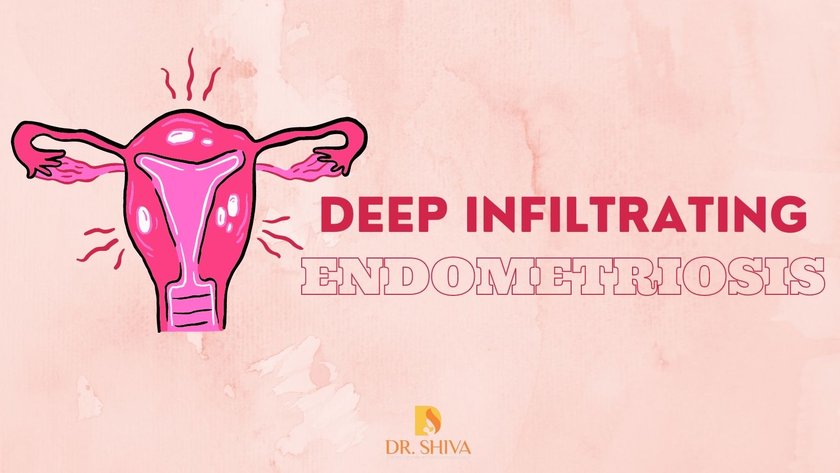 Deep infiltrating endometriosis