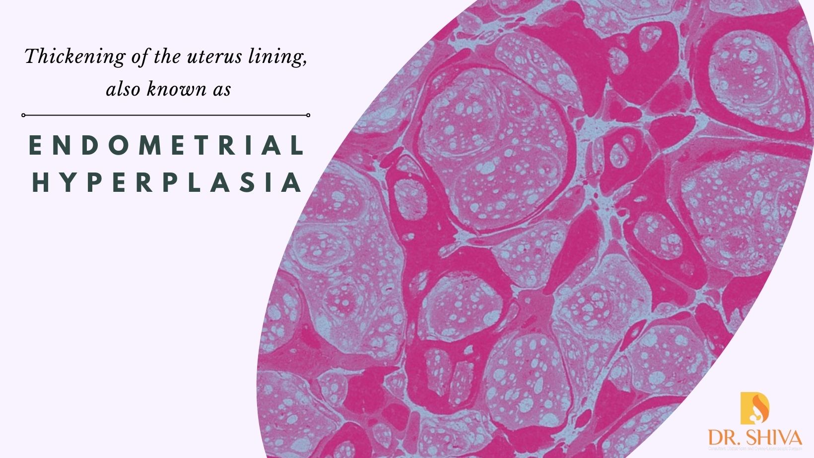 Endometrial Hyperplasia - Thickening of the uterus lining