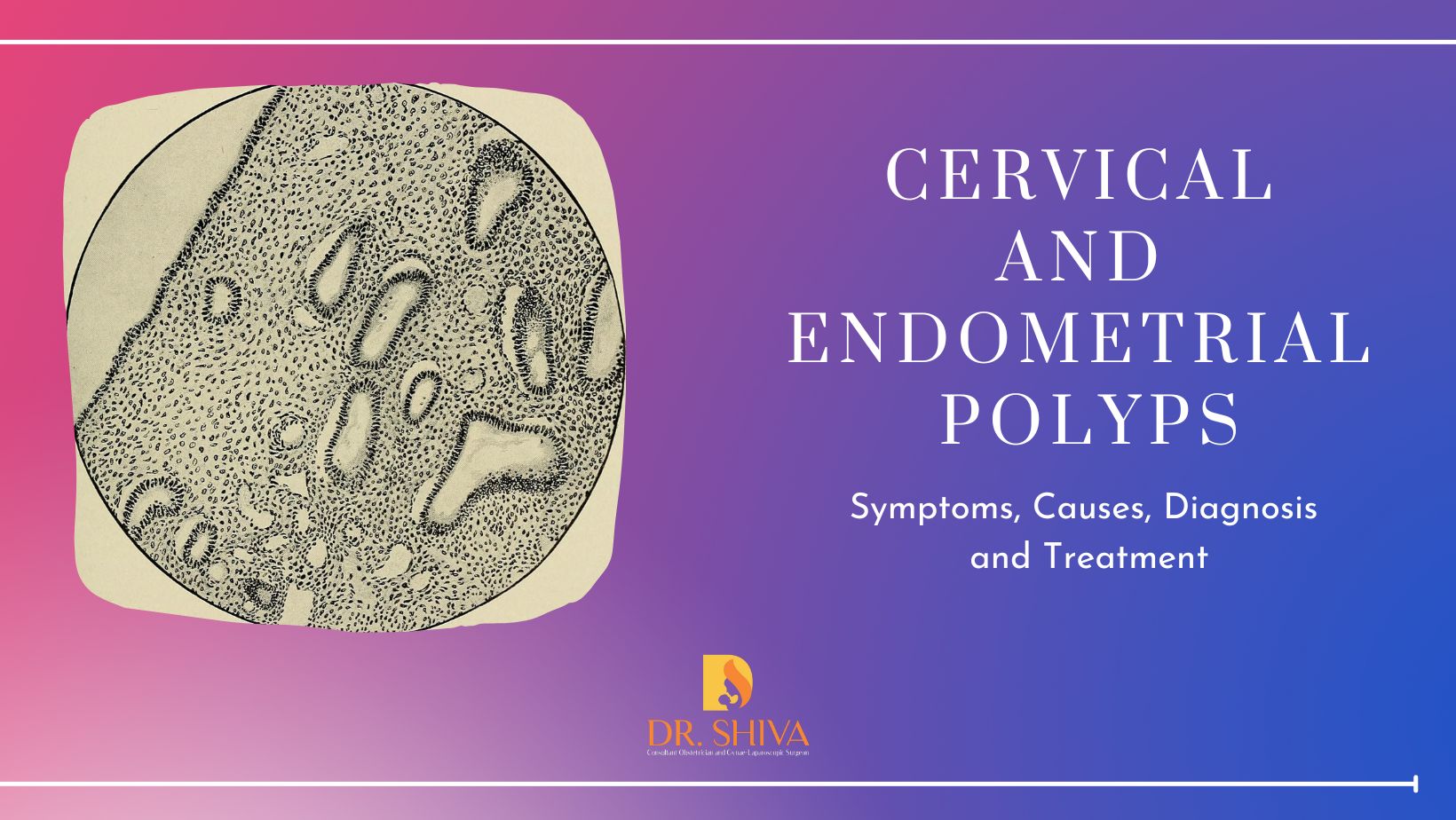 Cervical and Endometrial polyps