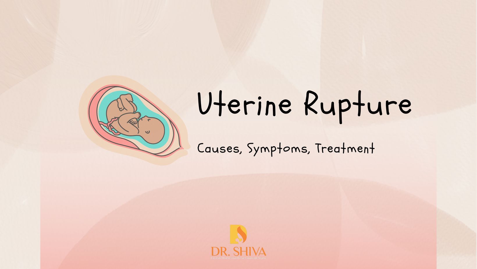 Uterine Rupture - Causes, Symptoms, Treatment, Prevention
