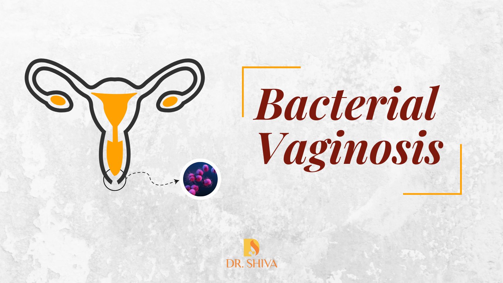 Bacterial Vaginosis