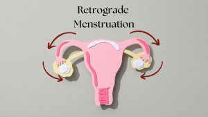 Retrograde Menstruation - Dr. Shiva