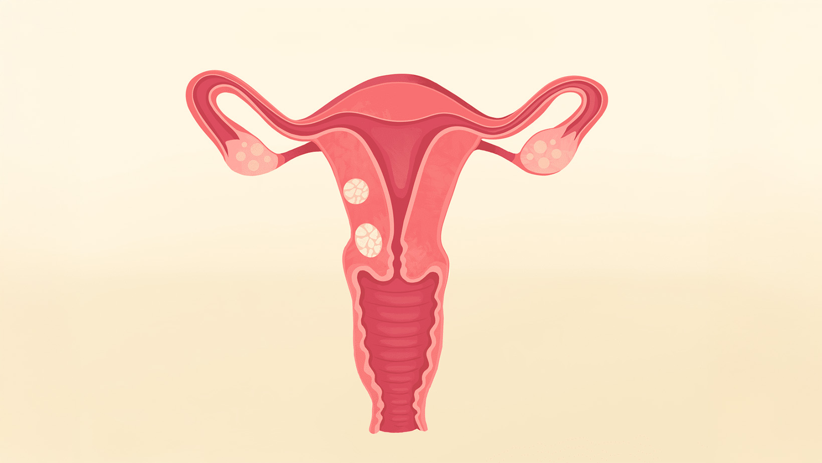 Uterine Fibroids – Symptoms, Treatments, and Case Reports